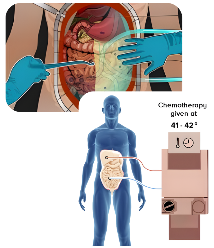 HIPEC Treatment