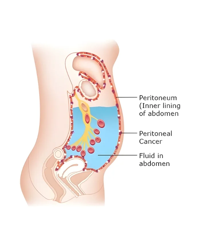Gastrointestinal cancers with peritoneal spread