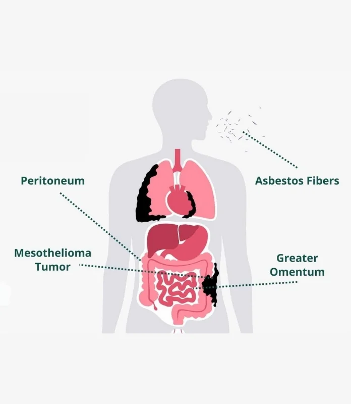 Mesothelioma involving the abdominal lining