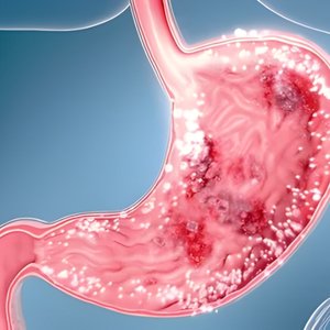 Chronic gastritis or ulcers