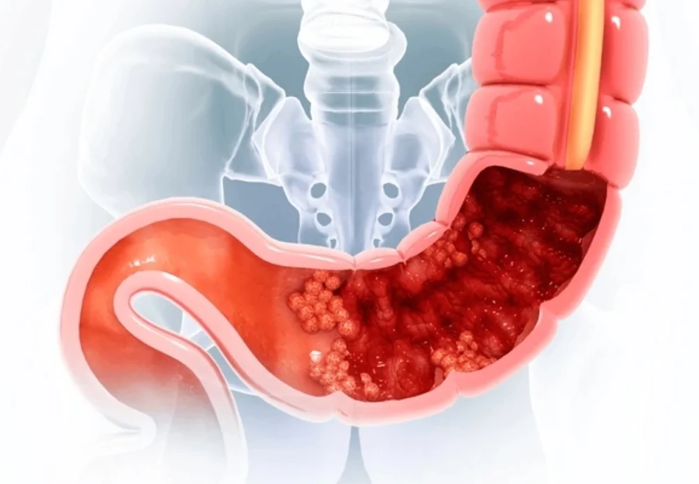 Colon Cancer