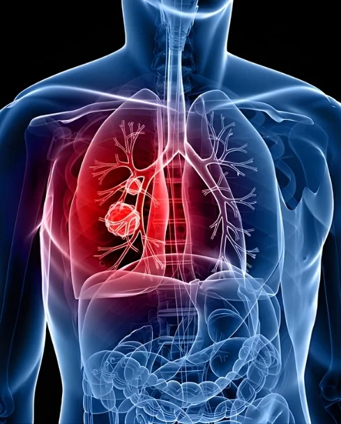 Thoracic Cancer
