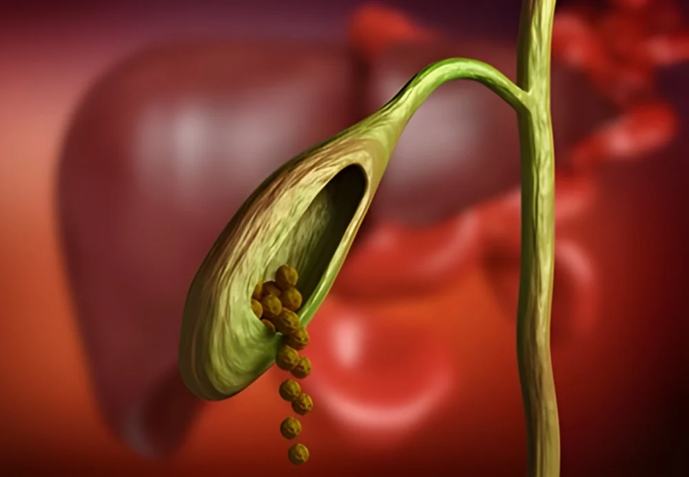 Gall Bladder Treatment