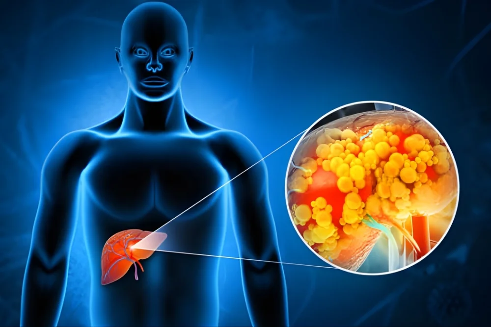 Liver Cancer