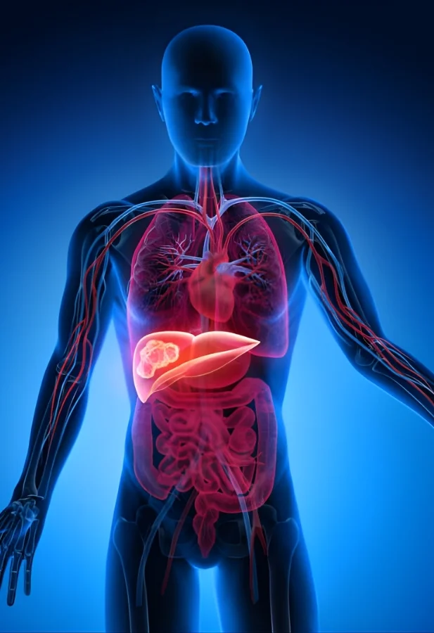 Liver Cancer