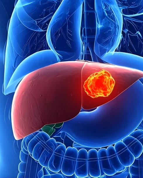 Liver Cancer Treatment