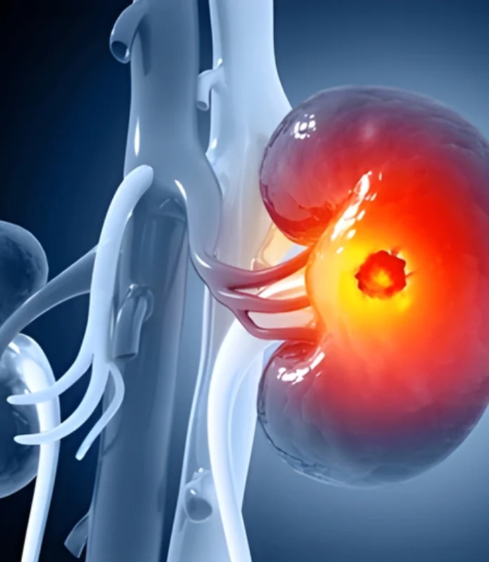 Kidney Cancer
