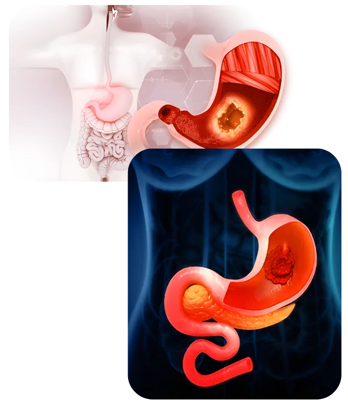 Gastrointestinal Cancer Surgery