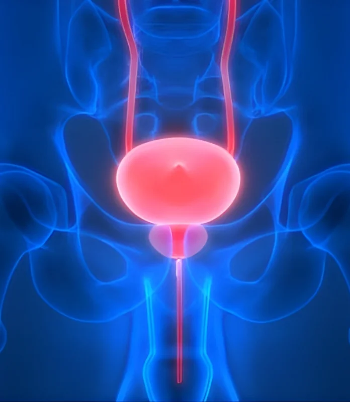 Neo Bladder Cancer Surgery