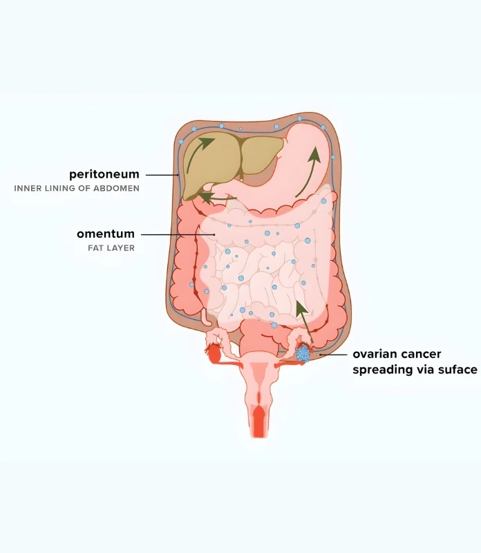 Peritoneal carcinomatosis from ovarian cancer