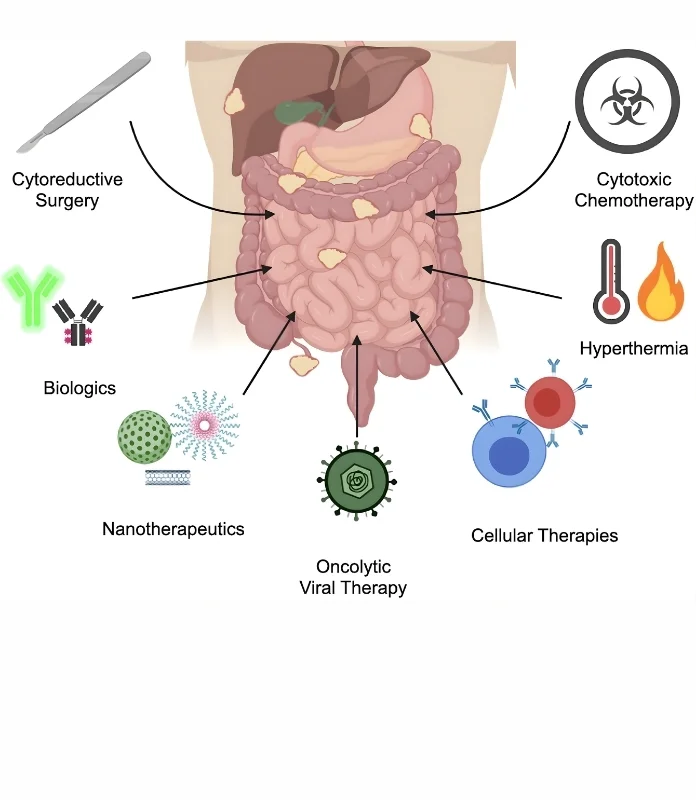 Peritoneal metastases
