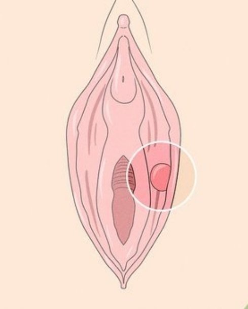 Vulva Treatment