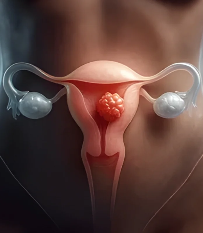 Gynecologic-Origin Cancers