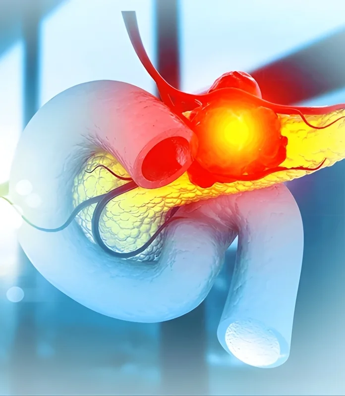 Pancreatic Cancer