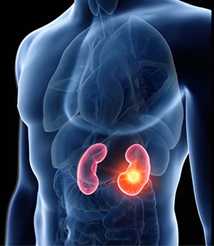 Tumour Involving Kidney