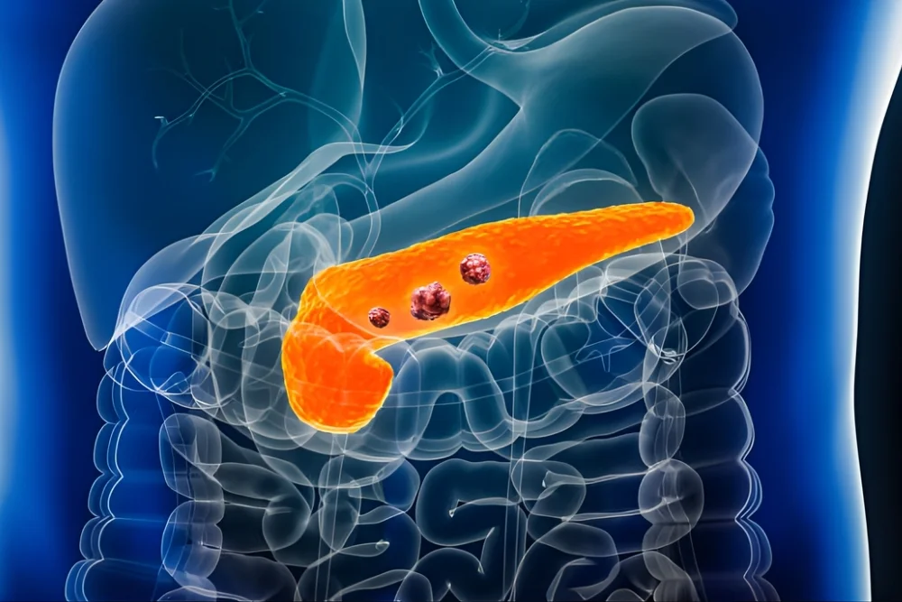 Pancreas Cancer