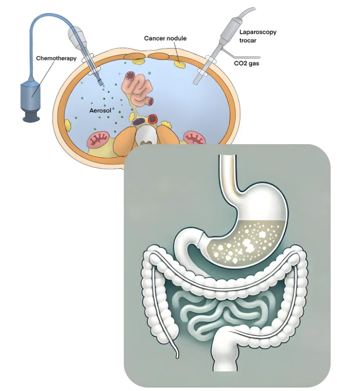 Pressurized Intraperitoneal Aerosol Chemotherapy