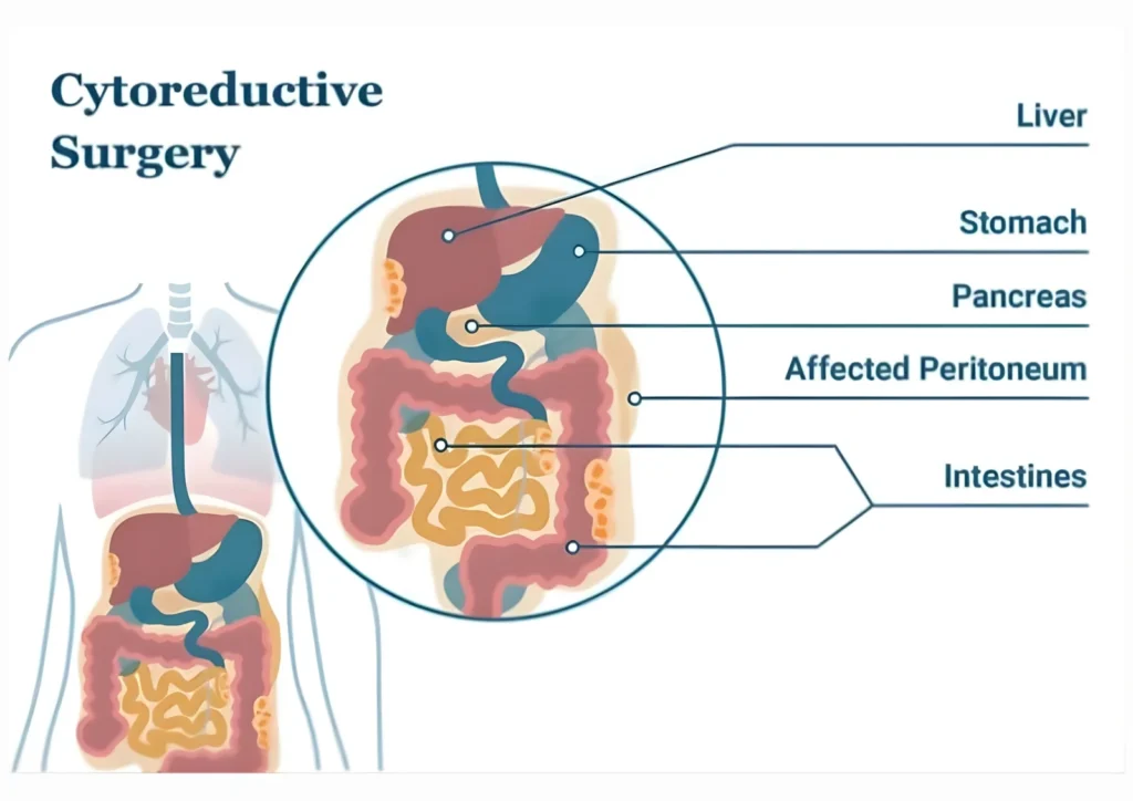 Cytoreductive Surgery