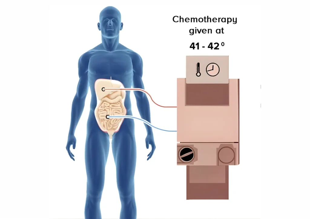 Heated Chemotherapy