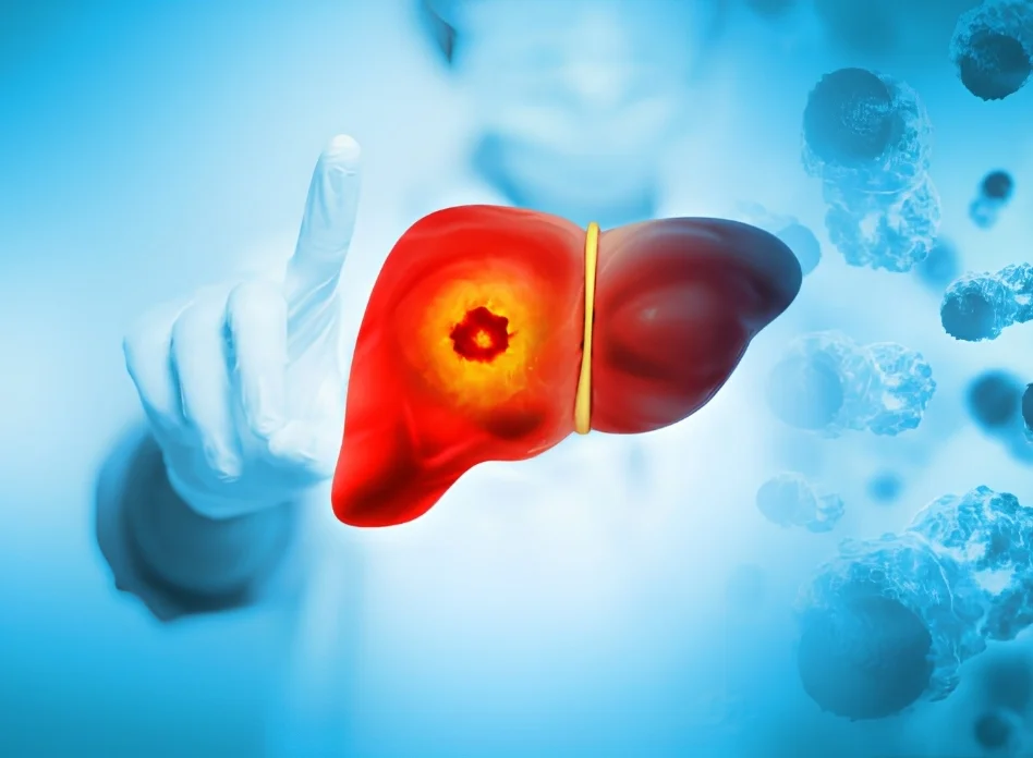 Primary liver cancer (hepatocellular carcinoma)