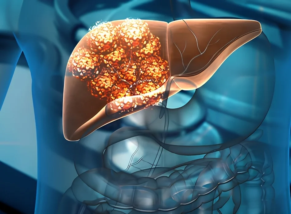 Metastatic liver tumors