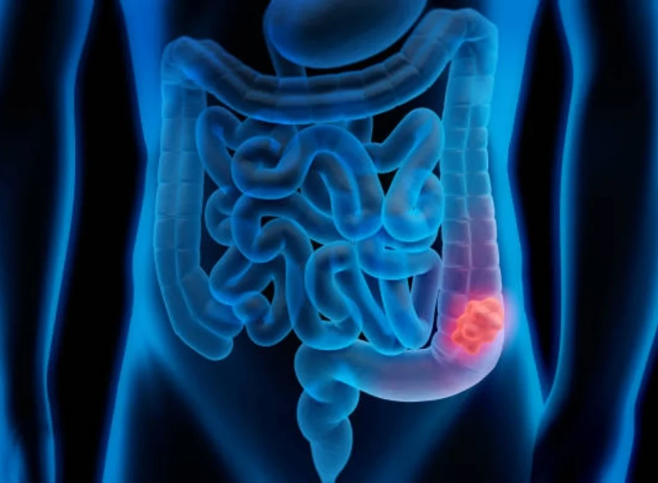 Colon and rectal cancers
