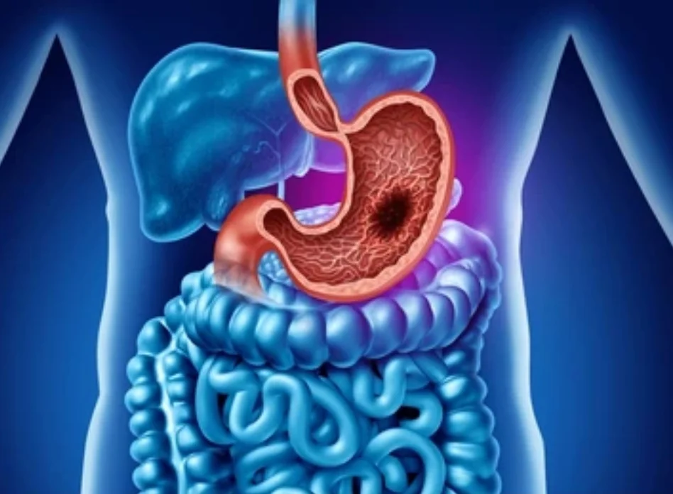 Stomach (gastric) cancer