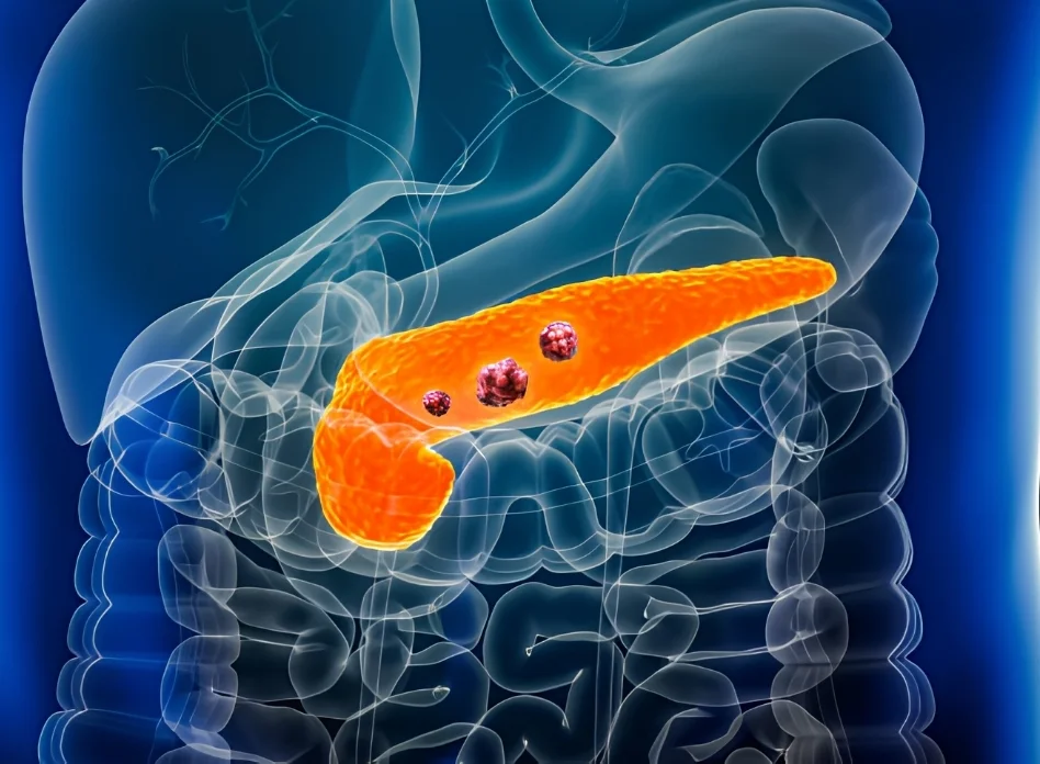 Liver and pancreatic tumors