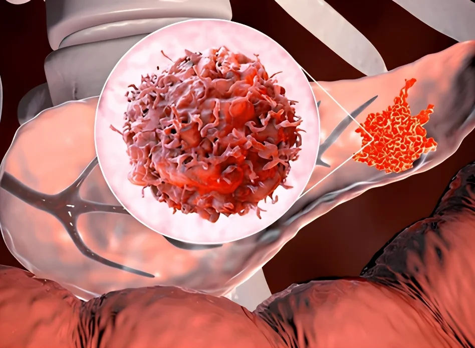 Pancreatic cancer (malignant tumors)