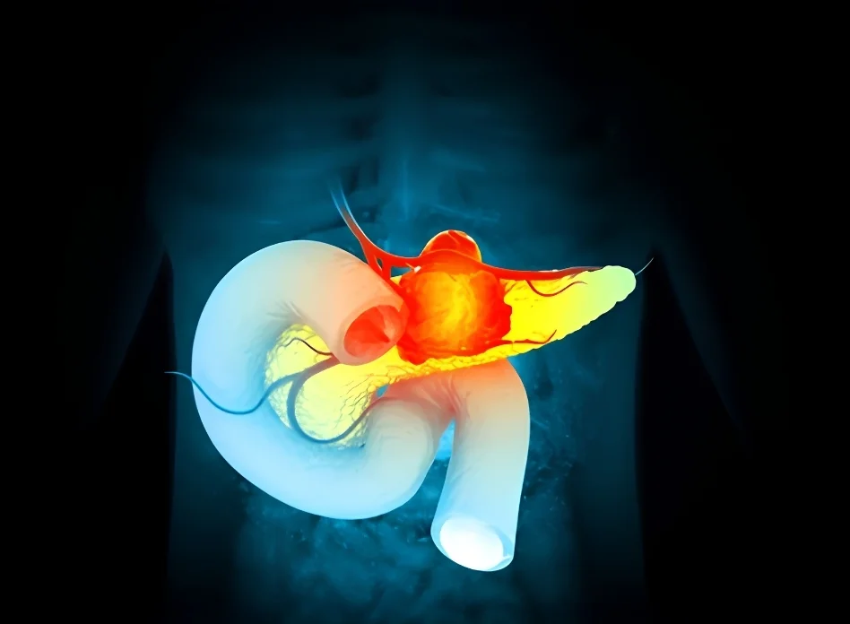 Benign pancreatic tumors