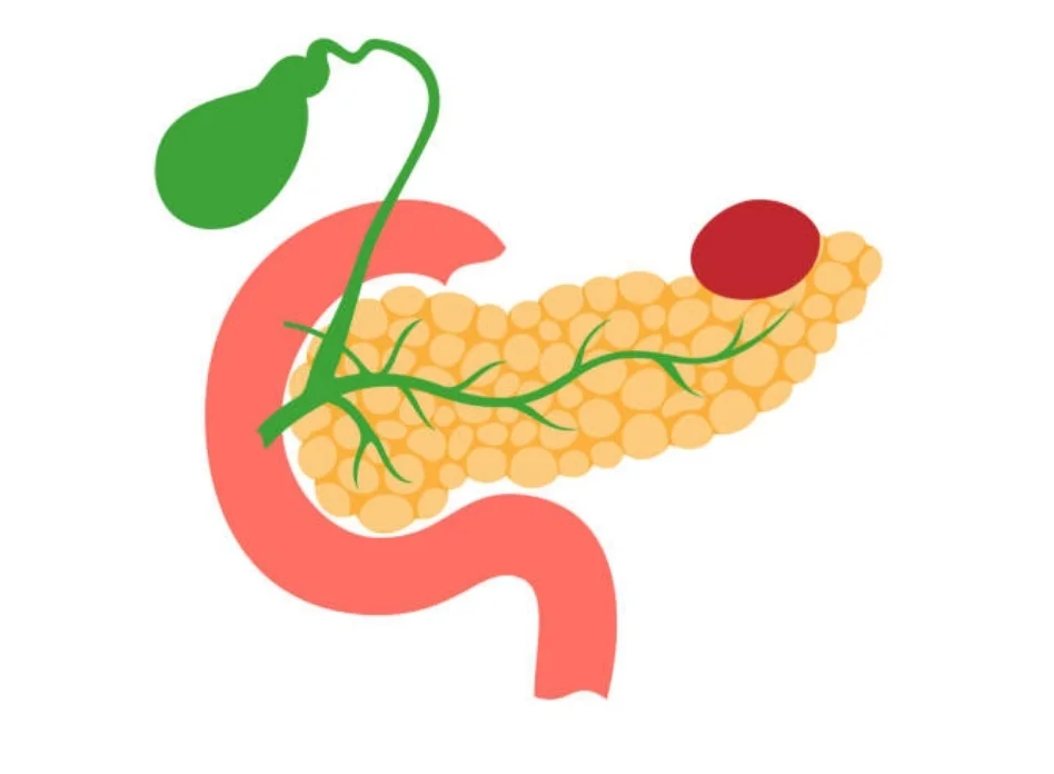 Pancreatic cysts requiring surgery