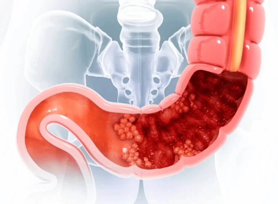 Benign colon tumors requiring surgery