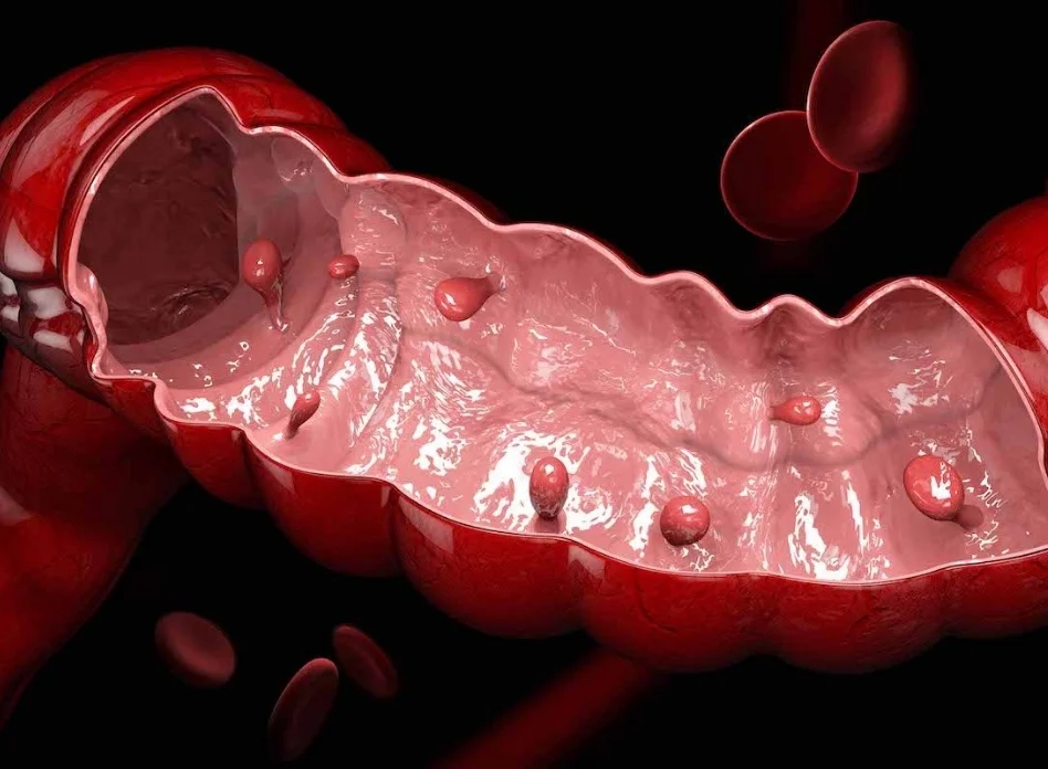 Polyps that cannot be removed endoscopically