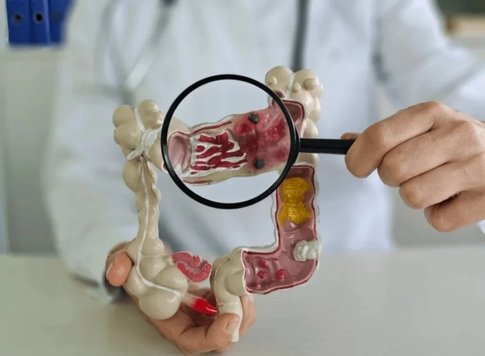 Complex colorectal conditions