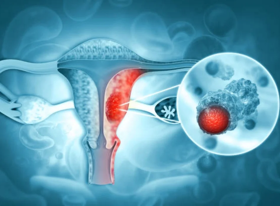 Advanced cervical cancer requiring surgery