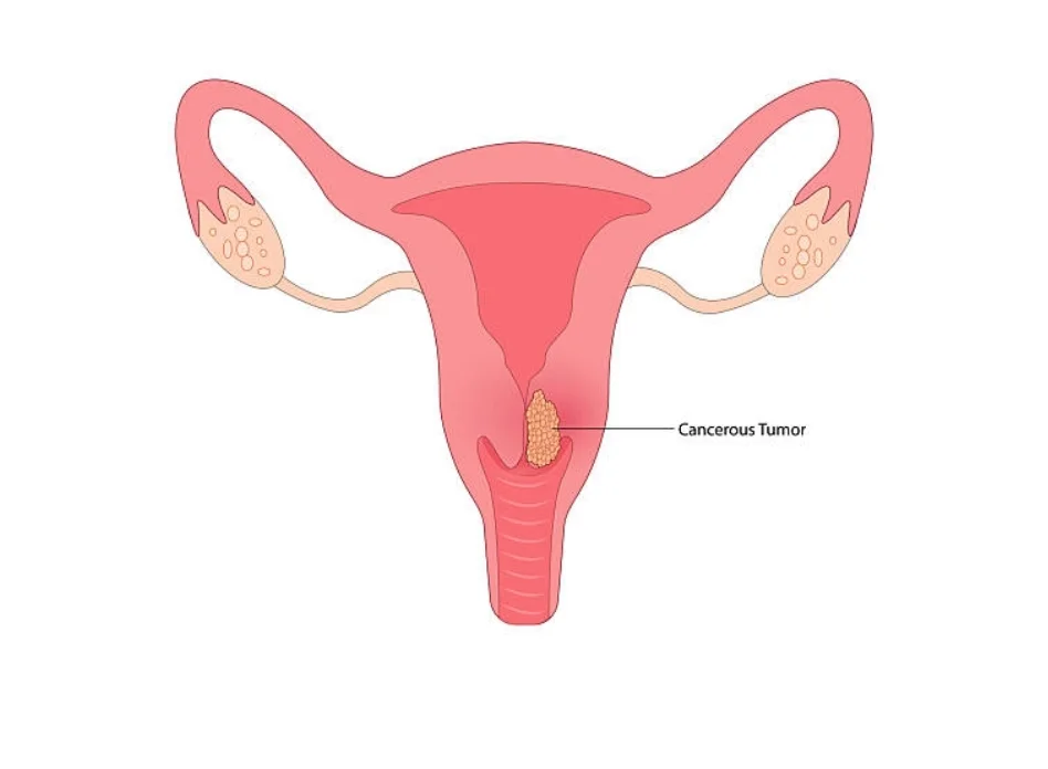Precancerous cervical conditions