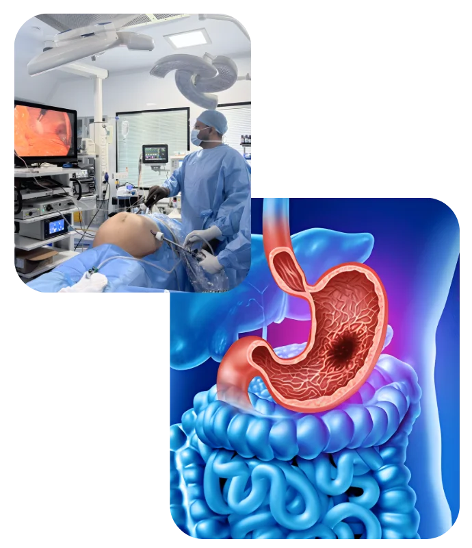 GI Cancer
