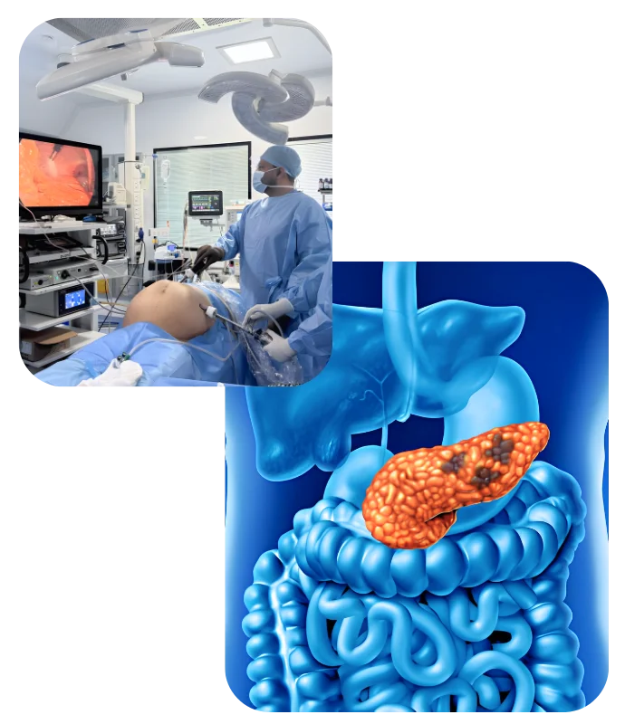 Pancreas Cancer