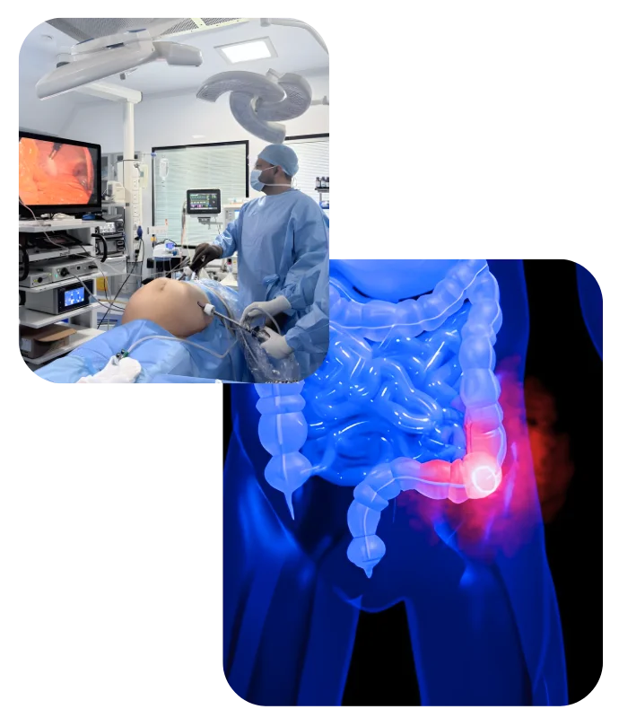 Colon Cancer
